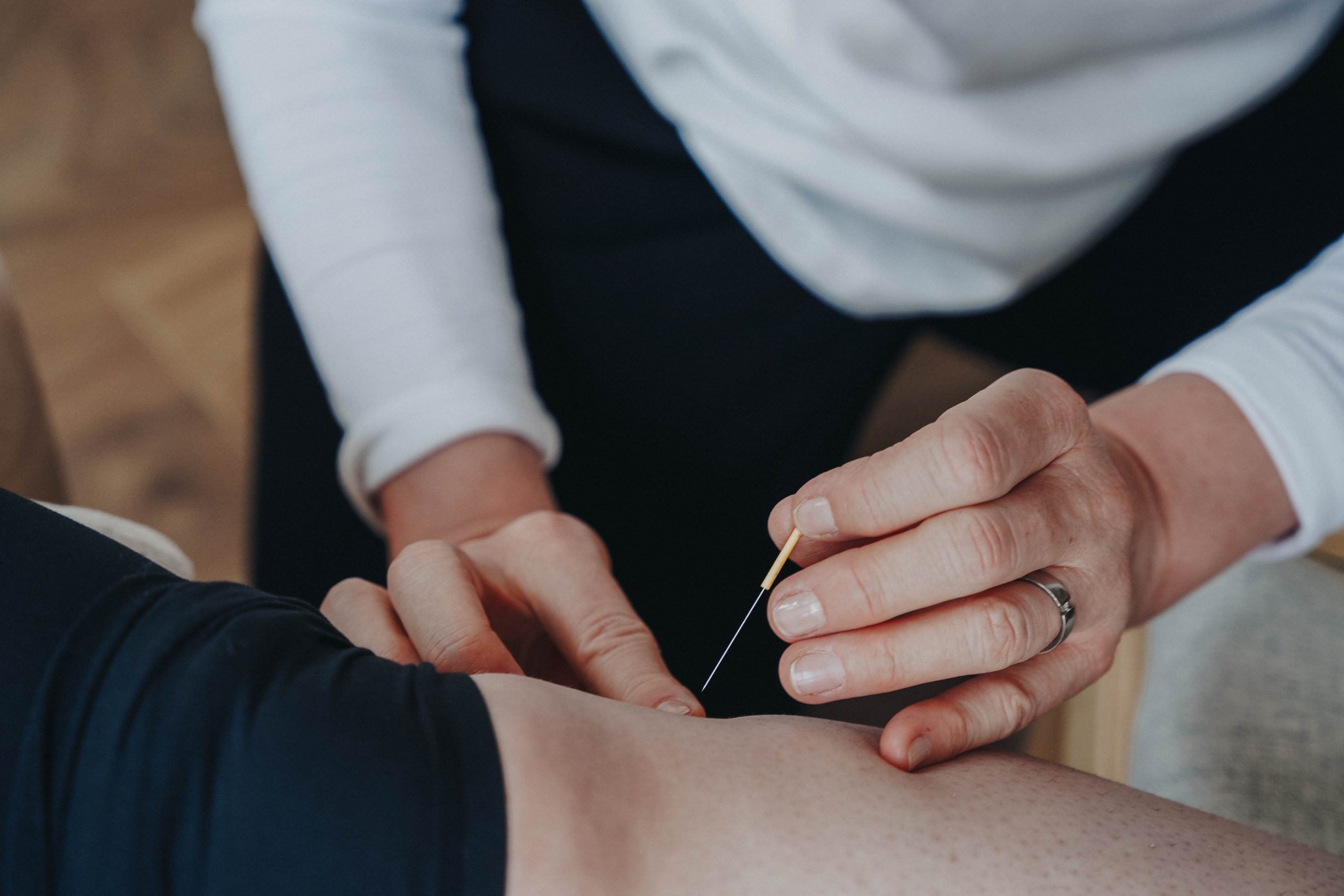 Akupunktur ist eines der Hebammenangebote in Dresden